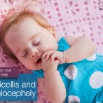 Torticollis and Plagiocephaly: Prevention and Getting Help